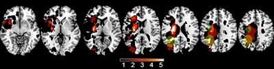 Predicting Gains With Visuospatial Training After Stroke Using an EEG Measure of Frontoparietal Circuit Function